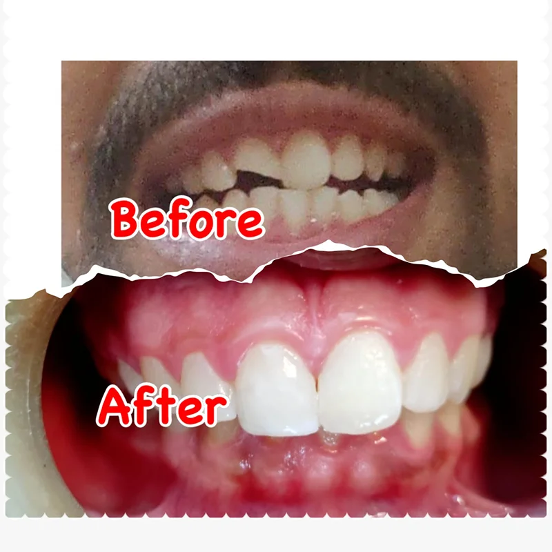Before and After