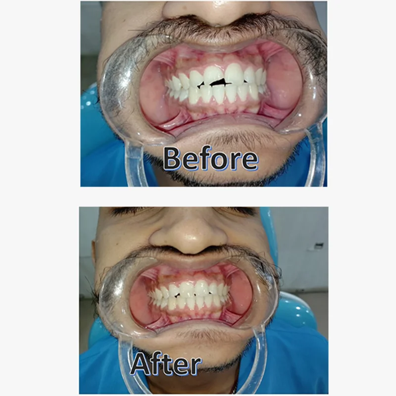 Before and After